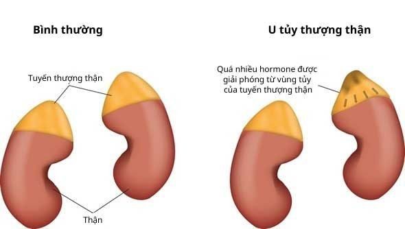 U Tủy Thượng Thận Pheochromocytoma