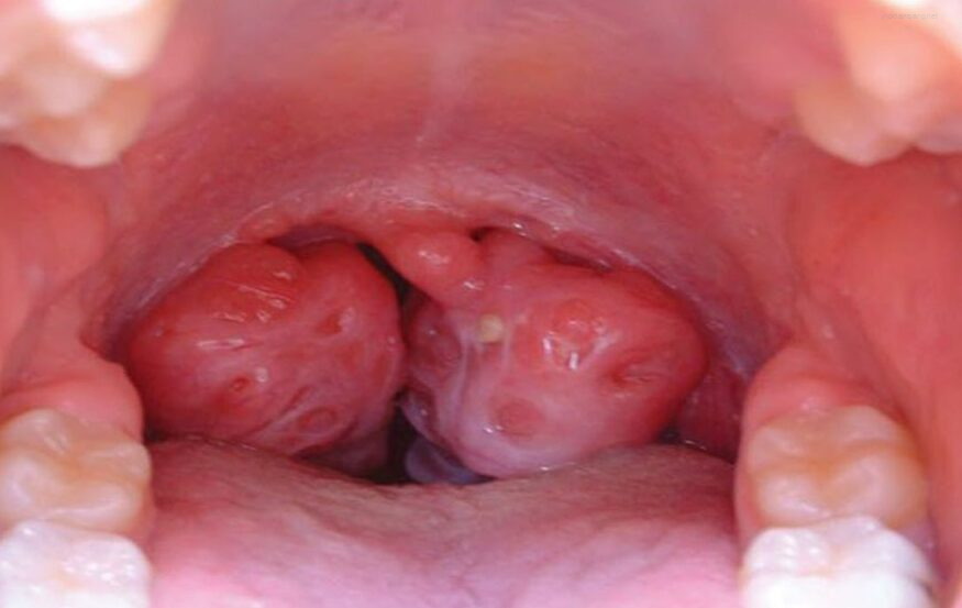 Áp- xe thành sau họng ở trẻ em Áp- xe thành sau họng ở trẻ em