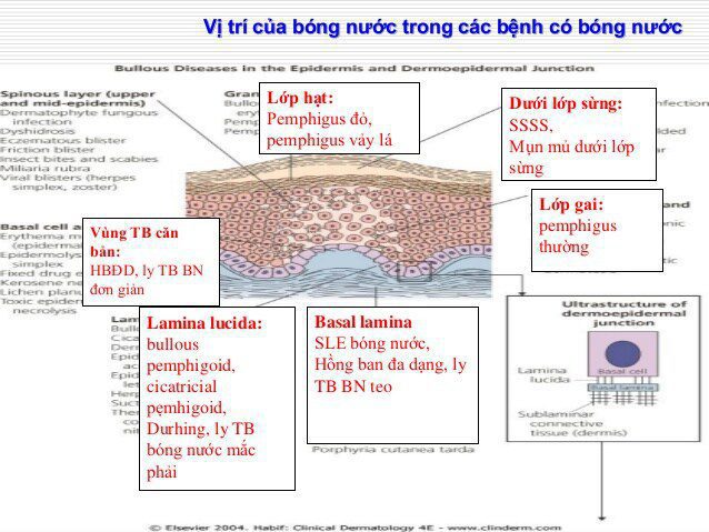 Bài giảng bỏng nước dạng pemphigus (BULLOUS PEMPHIGOID)