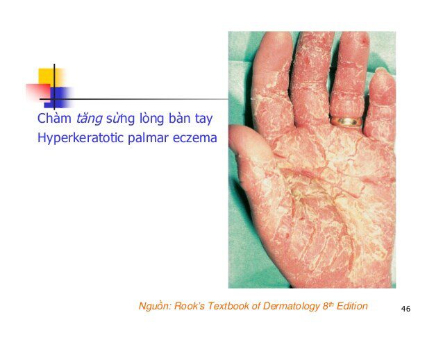 Bài giảng chàm bàn tay (HAND DERMATITIS)