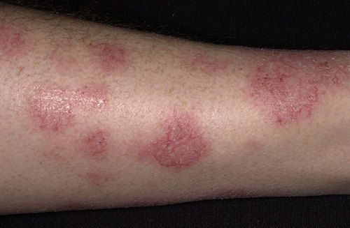 Bài giảng chàm thể tạng (Viêm da cơ địa ) (ATOPIC DERMATITIS, ATOPIC ECZEMA)