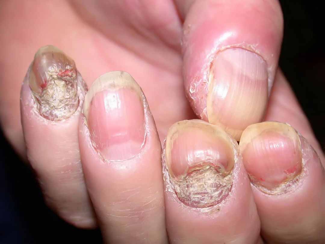 Bài giảng nấm móng (ONYCHOMYCOSIS)