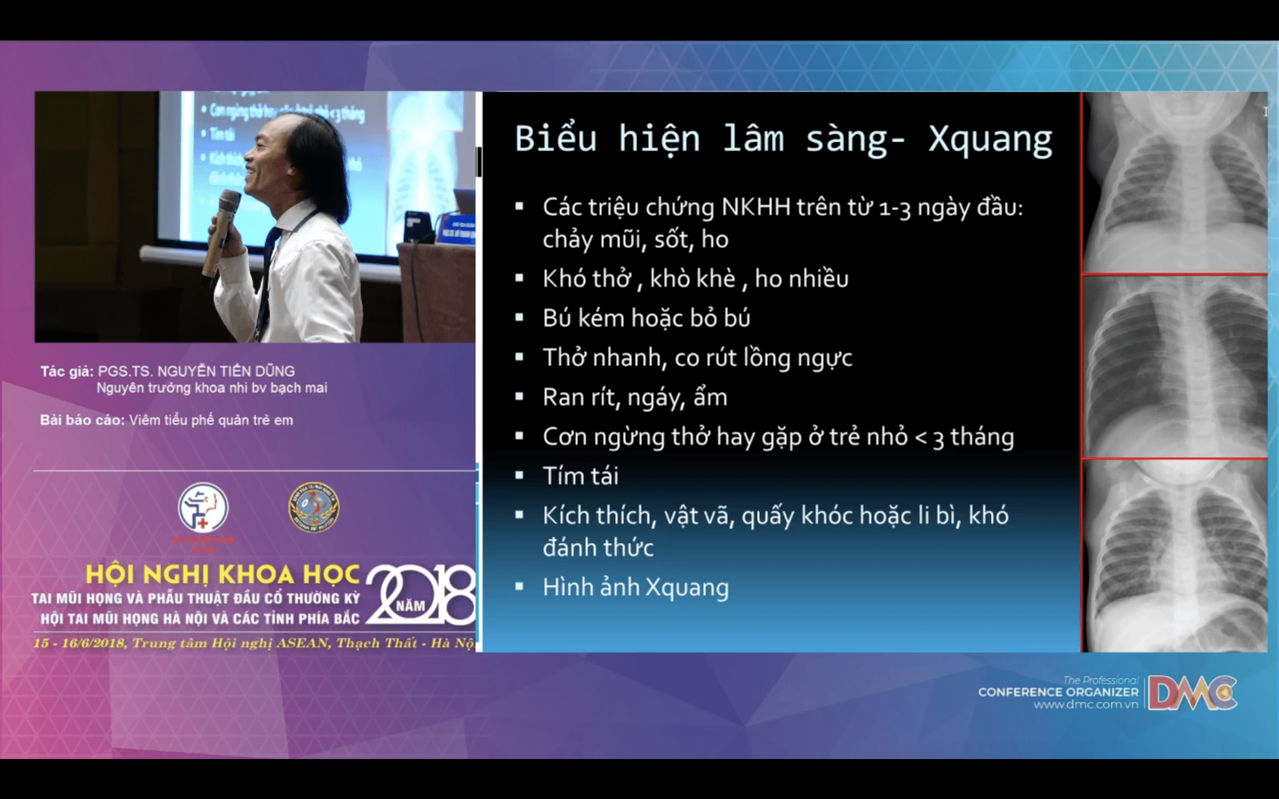 Bài giảng nhi khoa: Viêm tiểu phế quản