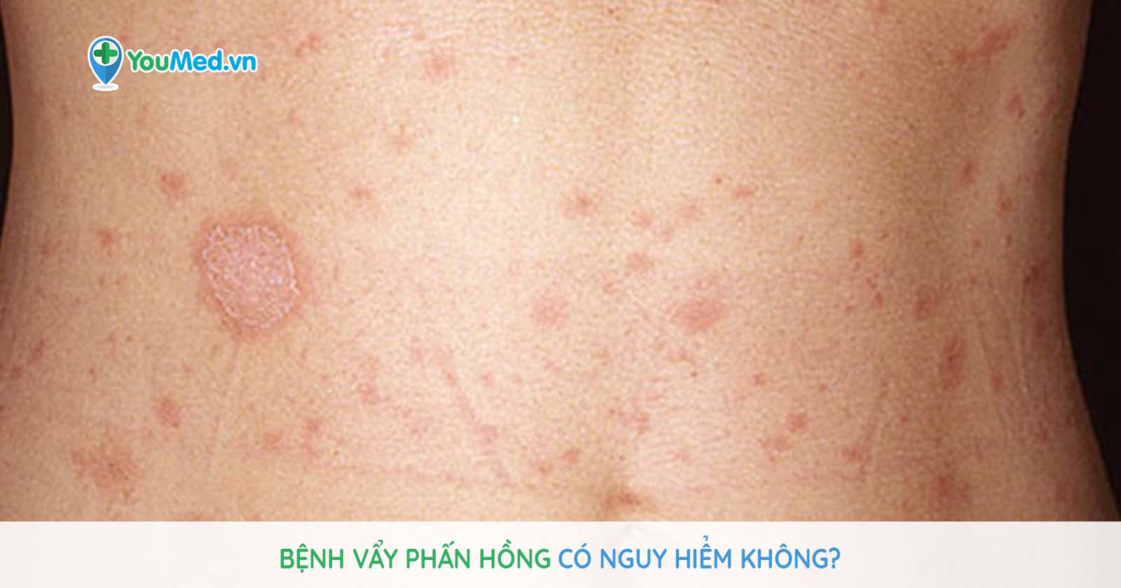 Bài giảng vảy phấn hồng