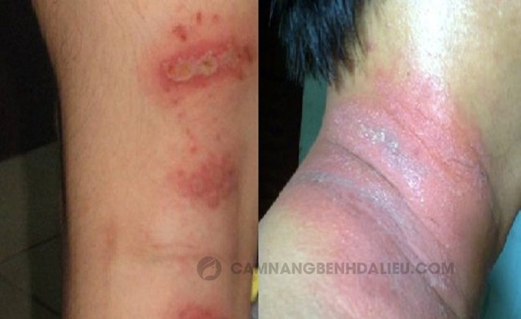 Bài giảng Viêm da tiếp xúc