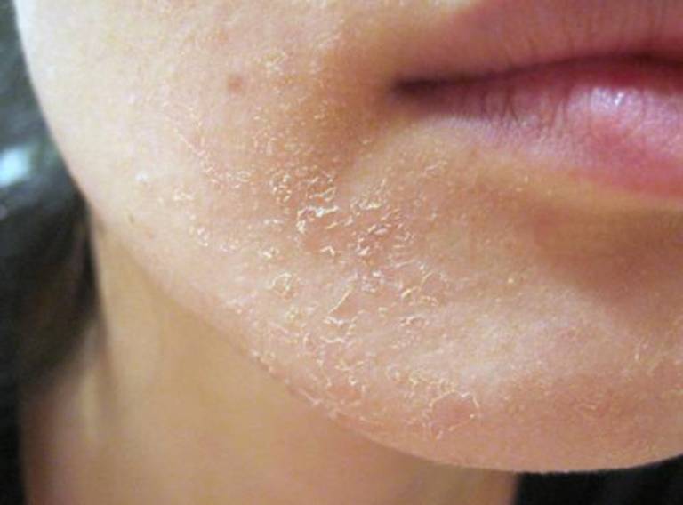 Bài giảng Viêm da tiết bã (Seborrheic dermatitis)