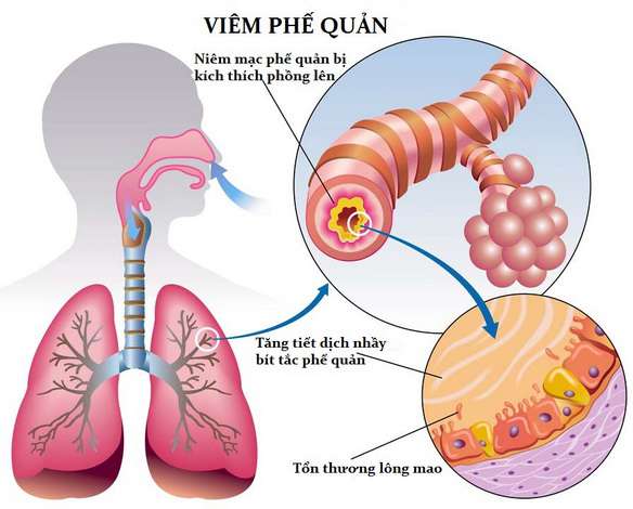 Bài Giảng Viêm Phế Quản Cấp – ĐH Y Hà Nội