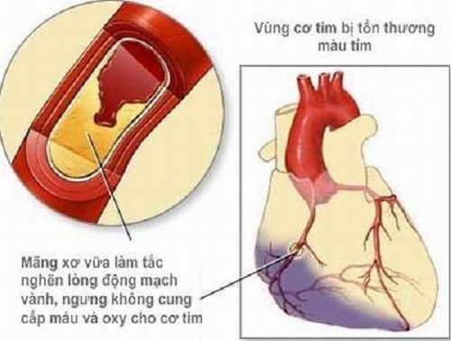 Bệnh cơ tim không do thiếu máu cục bộ