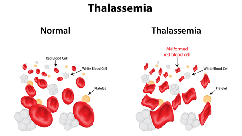 Bệnh huyết sắc tố (Thalassemla và huyết sắc tố bất thường)