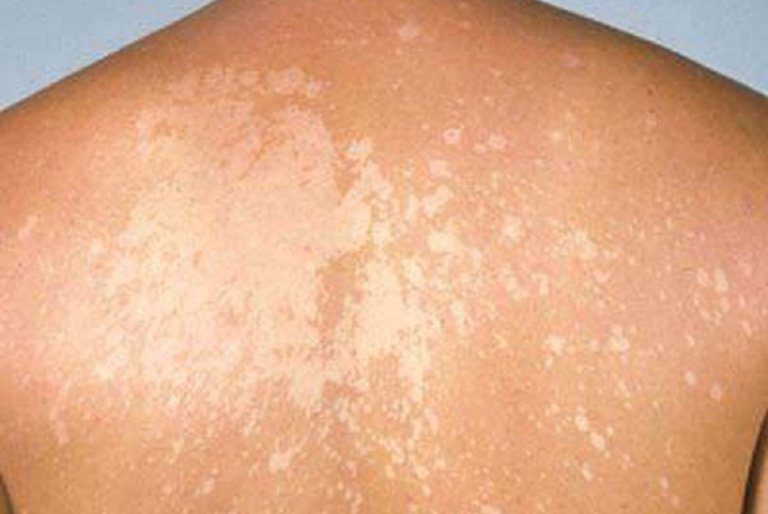 Bệnh lang ben (TINEA VERSICOLOR)