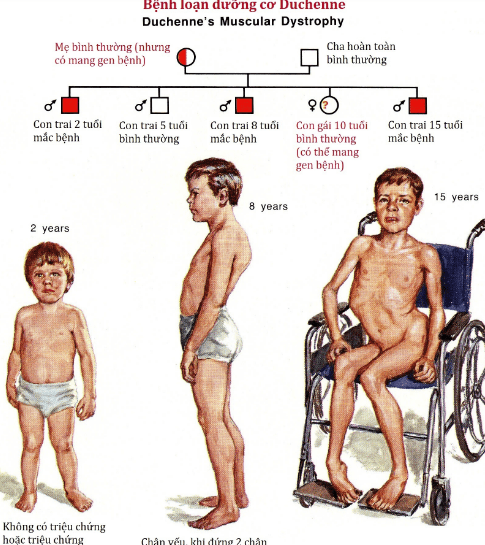 Bệnh loạn lưỡng cơ Duchenne (DMD: Duchenne Muscular Dystrophy)