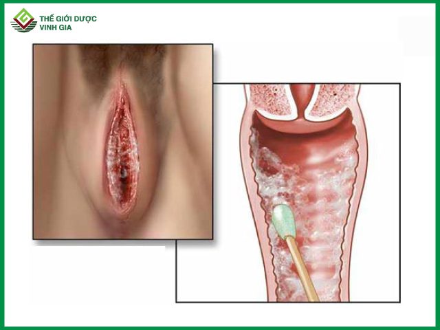 Bệnh nấm candida