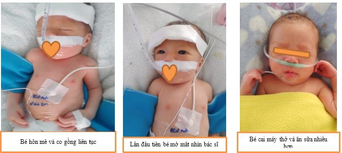 Bệnh Não Thiếu Oxy Thiếu Máu Cục Bộ ở trẻ sơ sinh