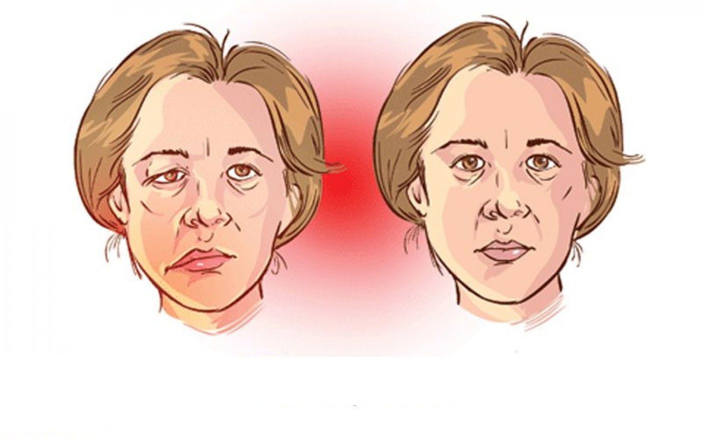 Bệnh nhược cơ