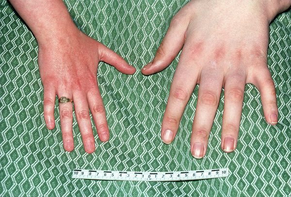 Bệnh To Đầu Chi (Acromegaly)