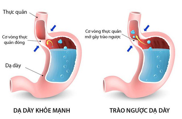 Bệnh trào ngược dạ dày – thực quản
