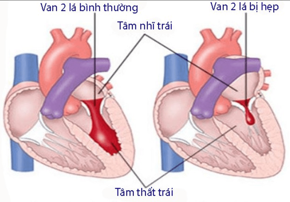 Bệnh van tim và thai kỳ