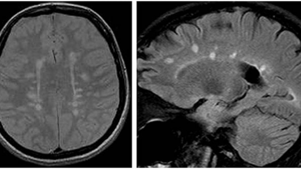 Bệnh xơ cứng rải rác (Multiple Sclerosis)