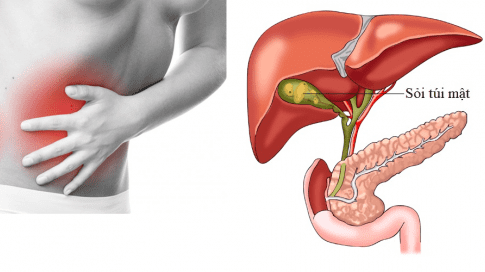 Biến chứng của sỏi mật – thái độ xử trí