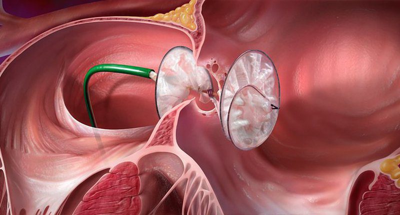 BÍT LỖ THÔNG LIÊN NHĨ/ LIÊN THẤT/ ỐNG ĐỘNG MẠCH