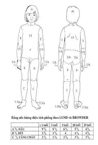 Bỏng trẻ em