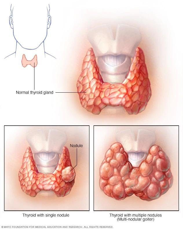 Bướu Giáp Độc Đa Nhân