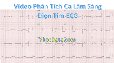 Ca lâm sàng điện tâm đồ 47