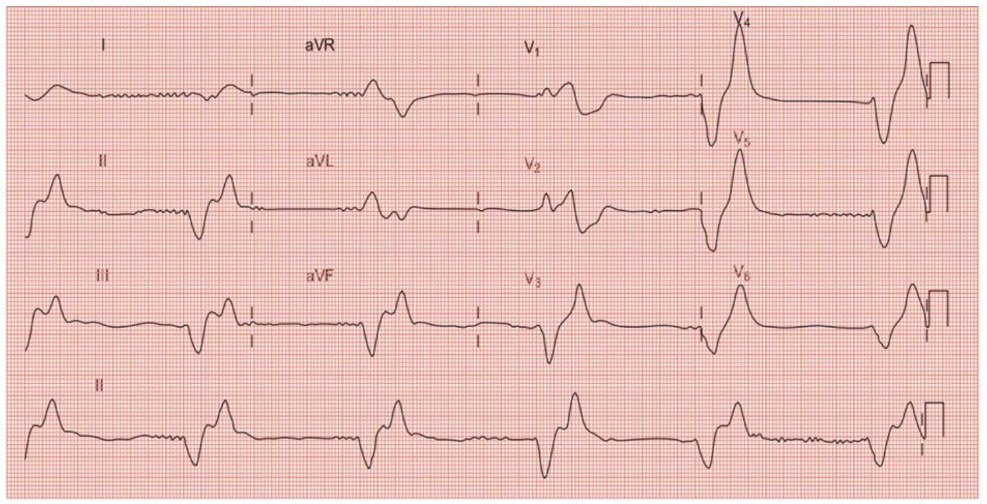 Ca lâm sàng điện tâm đồ 56