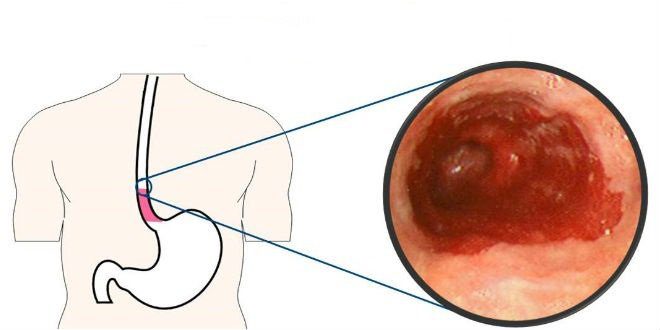 Các bệnh thực quản
