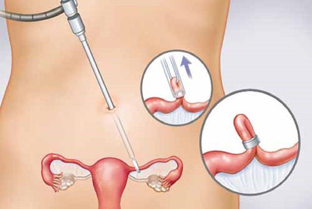 Các Phương Pháp Tránh Thai Vĩnh Viễn
