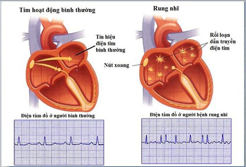 Các rối loạn nhịp tim thường gặp