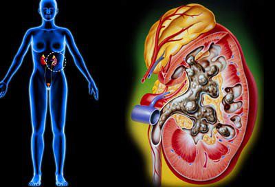 Cấp cứu và điều trị viêm thận bể thận cấp