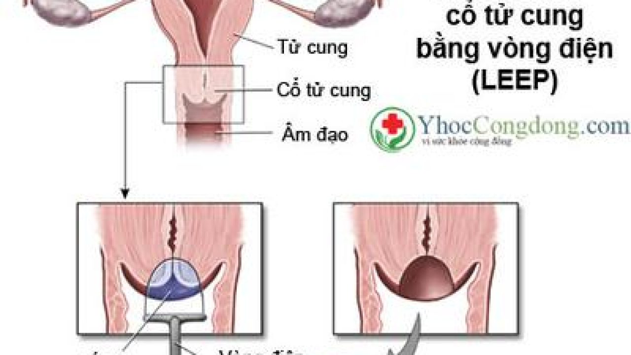 Cắt Cổ Tử Cung Bằng Vòng Nhiệt Điện (Leep)