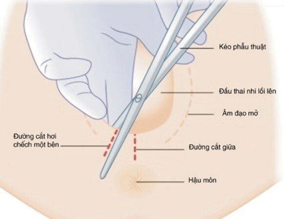Cắt Khâu Tầng Sinh Môn Cắt Khâu Tầng Sinh Môn