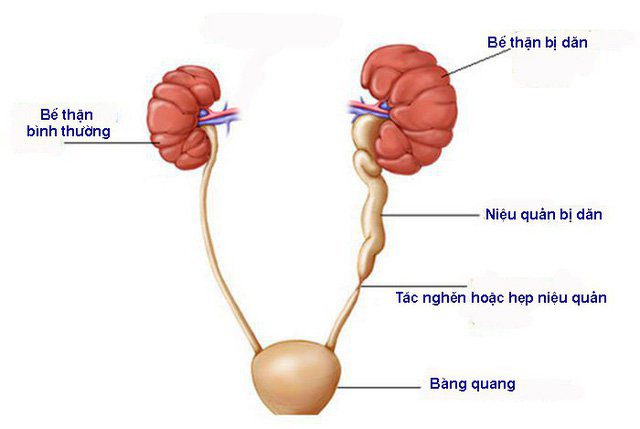 Cắt toàn bộ thận và niệu quản