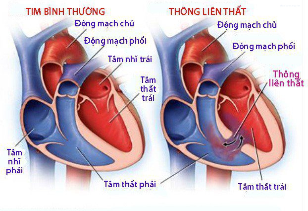 Chẩn đoán và điều trị thông liên thất