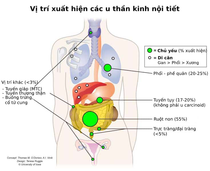 Chẩn đoán và điều trị U thần kinh nội tiết