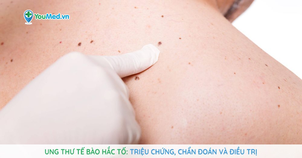 Chẩn đoán và điều trị Ung thư hắc tố