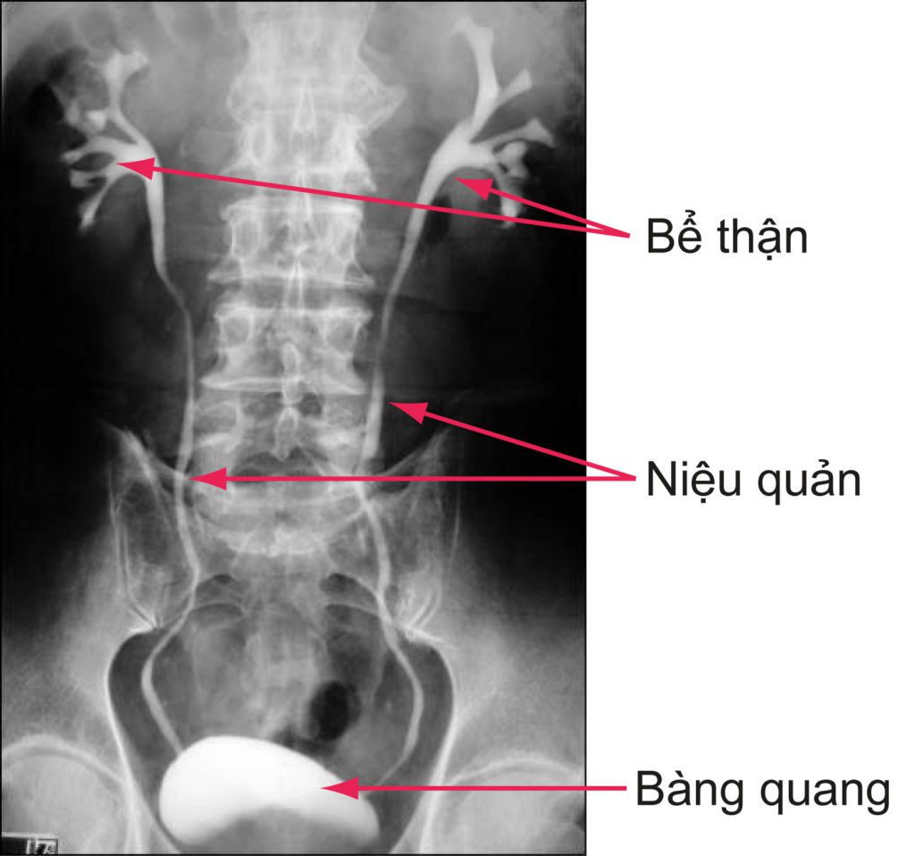 Chẩn đoán X Quang Tiết niệu