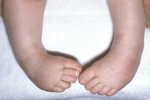 Chân khoèo bẩm sinh