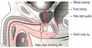 Chấn thương bàng quang kín