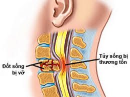 Chấn thương cột sống và tủy sống trẻ em