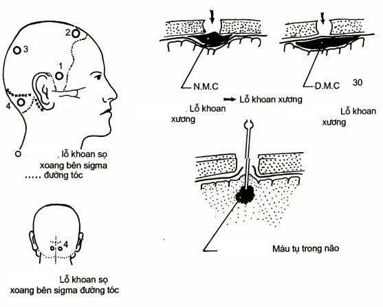 Chấn thương sọ não kín