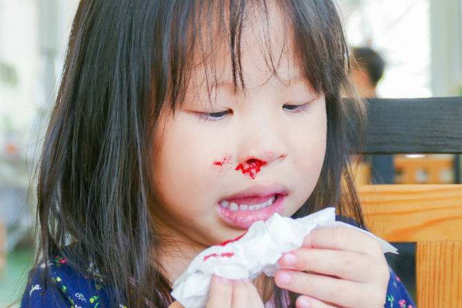 Chảy máu mũi ở trẻ em