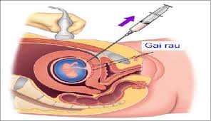 Chỉ Định Sinh Thiết Gai Nhau/Chọc Ối