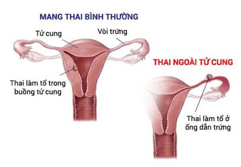 Chửa Ngoài Tử Cung