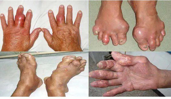 Cơn Viêm Khớp Gout Cấp