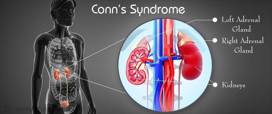 Cường Aldosteron Tiên Phát (Hội Chứng Conn)