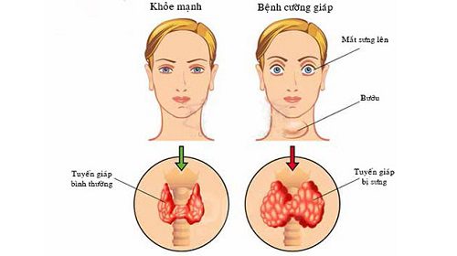 Cường Chức Năng Tuyến Giáp