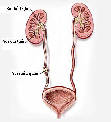 Dãn niệu quản